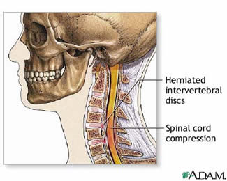 Cervical herniated disc