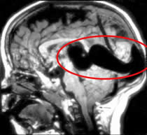 Vein of Galen malformation MRI