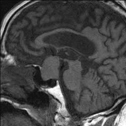 MRI of pituitary region