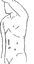Diagram of body after procedure